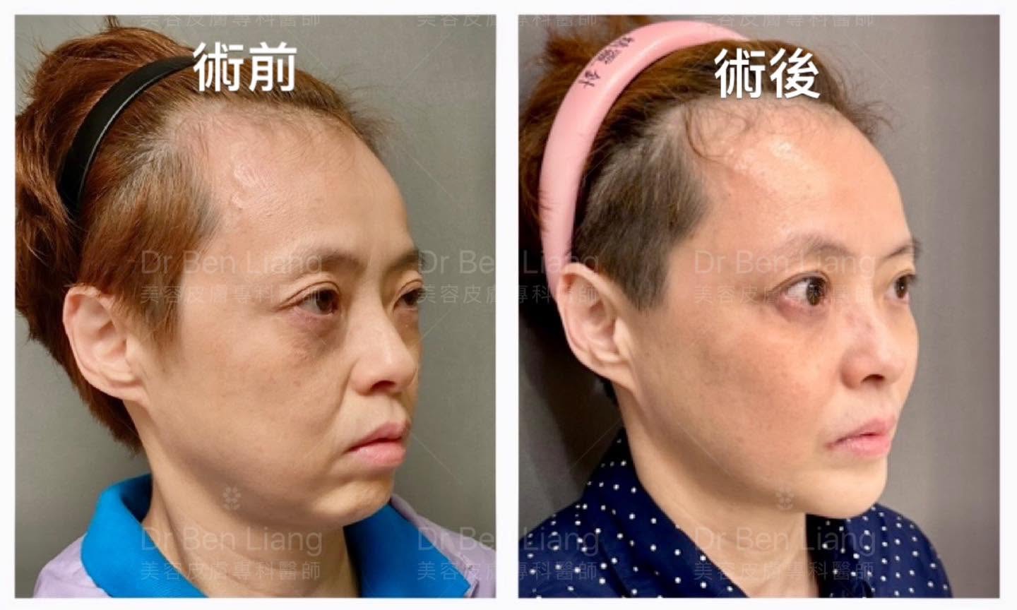 單次 18 CC 臉部玻尿酸結構治療案例追蹤
